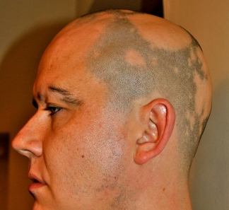 man with alopecia areata