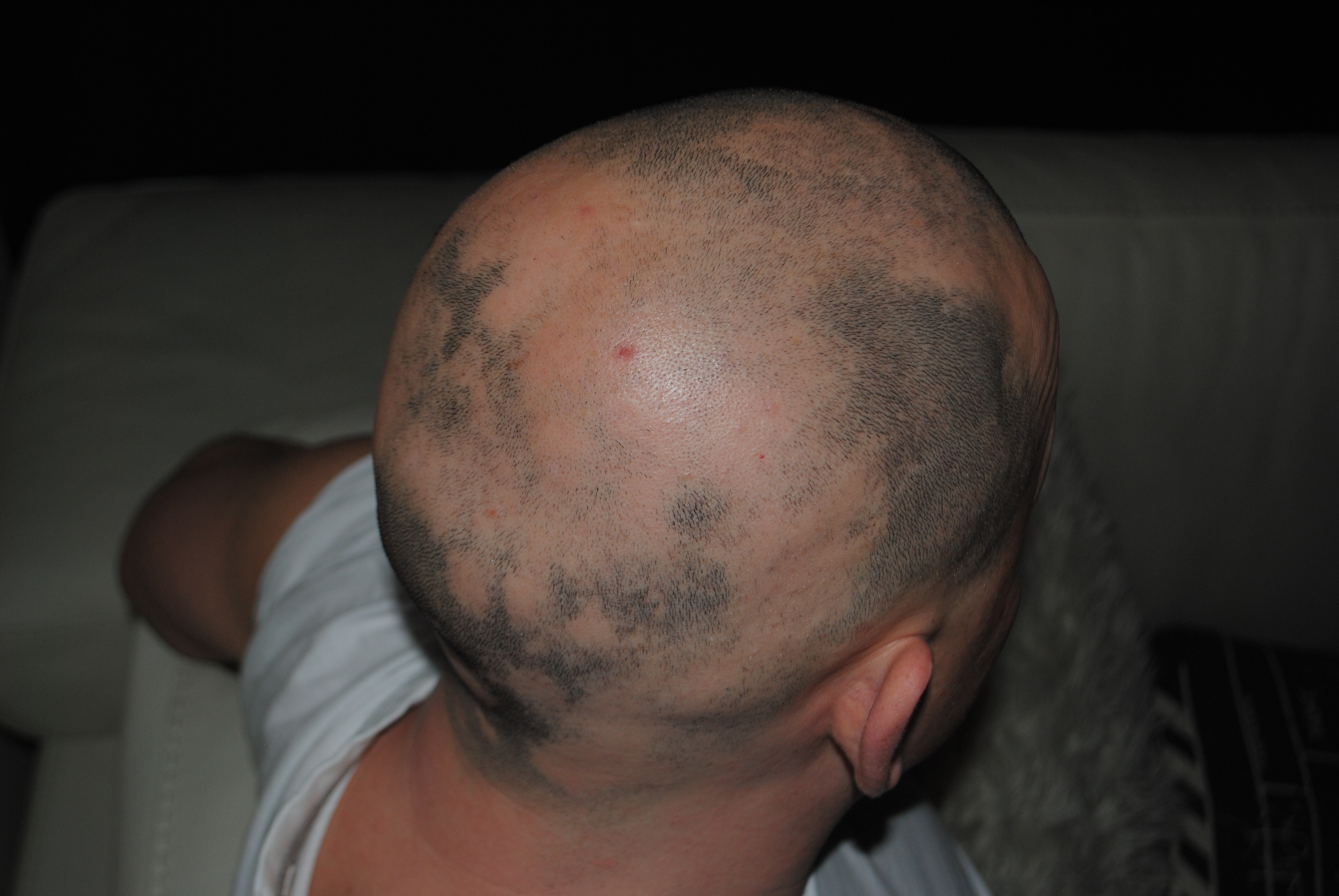 Alopecia Areata: Learn About Symptoms and Treatment